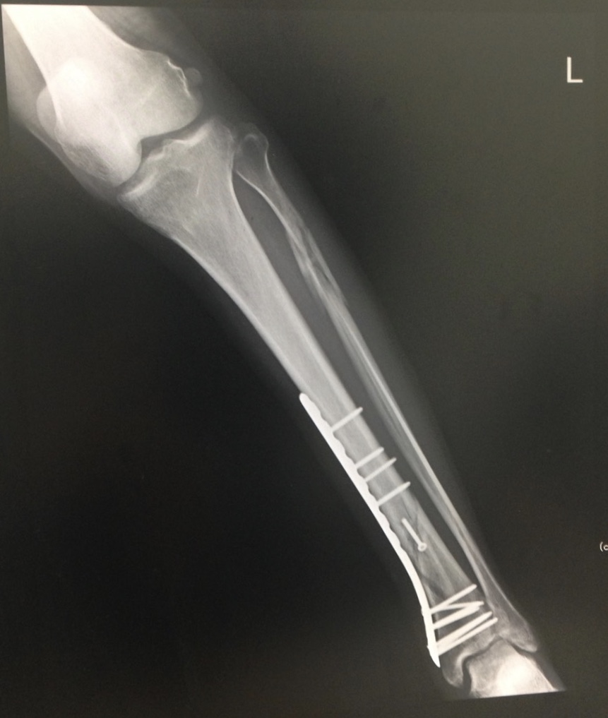 脛骨腓骨骨折 完治までの経過まとめ日記 骨折体験談26 やまはたブログ