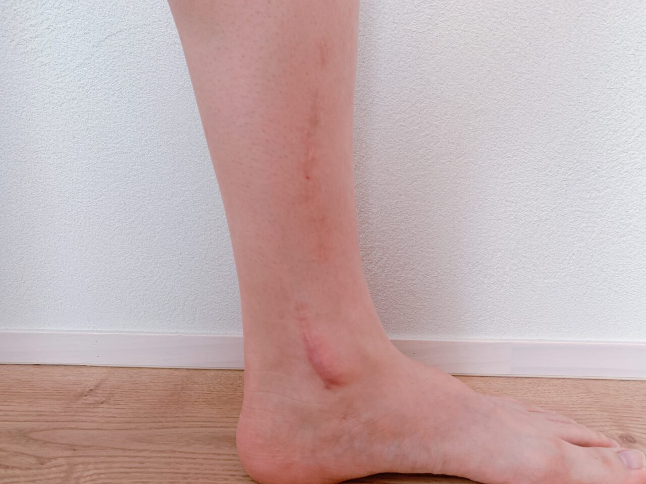 ケロイドや肥厚性瘢痕を防ぐにはどうすればよいでしょうか?